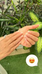 کاشت ناخن - بعد از درمان