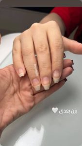 کاشت ناخن - قبل از درمان