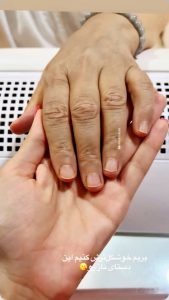 کاشت ناخن - قبل از درمان